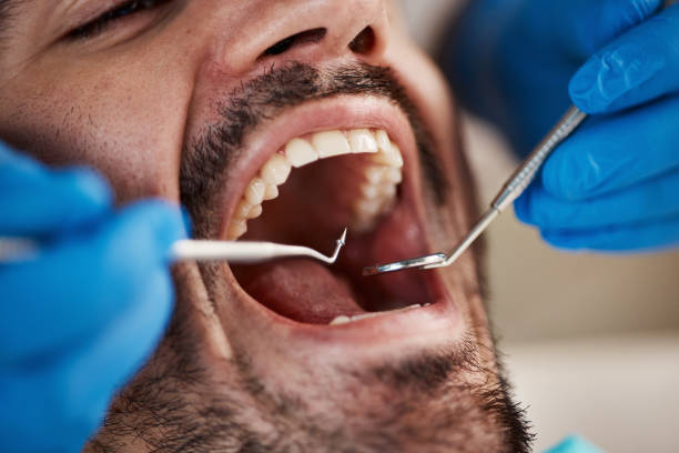 Best Emergency Dental Extractions in Marshfield, MO